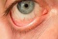 The manÃ¢â¬â¢s eye is gray-blue with red veins on it very close